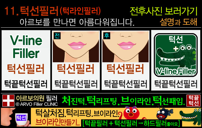 턱선필러,턱선패임필러,턱라인필러,브이라인,브이라인필러,브이라인턱,동안필러,턱선필러전후사진