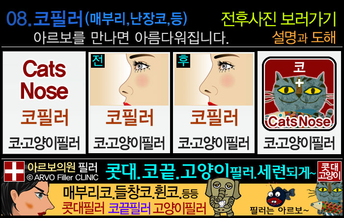 코필러,콧대필러,코끝필러,코필러전후사진,매부리코,새부리코,매부리코필러