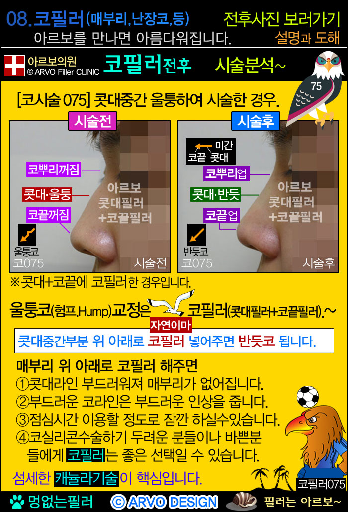 코필러,콧대필러,코끝필러,코필러전후설명,매부리코,새부리코,매부리코필러